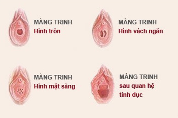 4 hình dạng cơ bản của màng trinh 4 hình dạng cơ bản của màng trinh