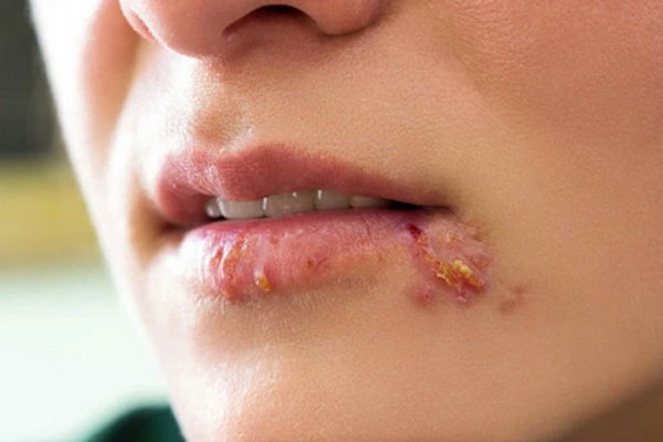 Bệnh herpes sinh dục có thể gây lở loét ở miệng Bệnh herpes sinh dục có thể gây lở loét ở miệng