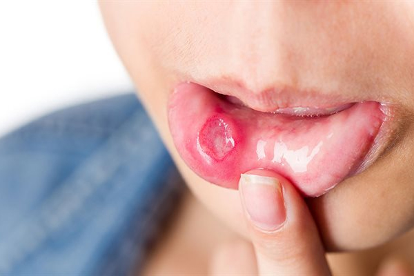 Virus HPV dẫn đến nguy cơ ung thư miệng và cổ họng. Virus HPV dẫn đến nguy cơ ung thư miệng và cổ họng.