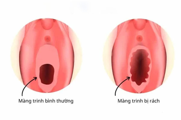 Màng trinh bị rách từ trước cũng là lý do không ra máu khi quan hệ lần đầu. Màng trinh bị rách từ trước cũng là lý do không ra máu khi quan hệ lần đầu.