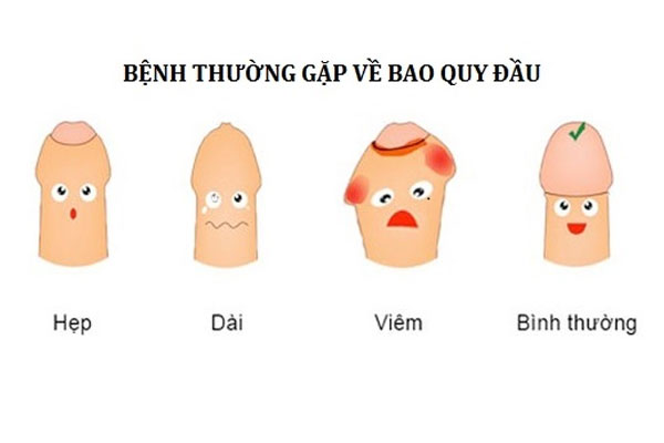 Hẹp bao quy đầu là tình trạng mà lớp da bao quanh đầu dương vật không thể tự tuột xuống để lộ hoàn toàn quy đầu. Hẹp bao quy đầu là tình trạng mà lớp da bao quanh đầu dương vật không thể tự tuột xuống để lộ hoàn toàn quy đầu.