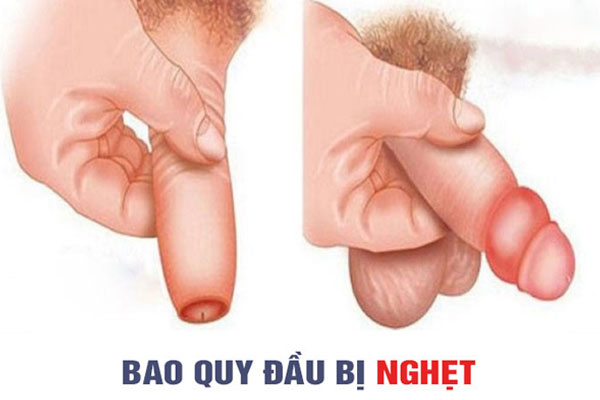 Nghẹt bao quy đầu là một tình trạng nguy hiểm khi bao quy đầu bị tuột ra khỏi đầu dương vật. Nghẹt bao quy đầu là một tình trạng nguy hiểm khi bao quy đầu bị tuột ra khỏi đầu dương vật.