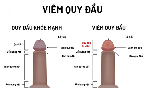 Viêm bao quy đầu do dị ứng xuất hiện các mảng màu xám, nâu hoặc đỏ. Viêm bao quy đầu do dị ứng xuất hiện các mảng màu xám, nâu hoặc đỏ.