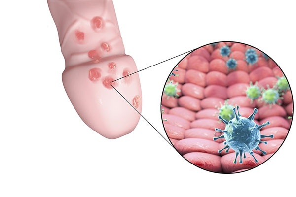 Dương vật nổi mụn do nhiều nguyên nhân khác nhau như bệnh lý hoặc sinh lý. Dương vật nổi mụn do nhiều nguyên nhân khác nhau như bệnh lý hoặc sinh lý.
