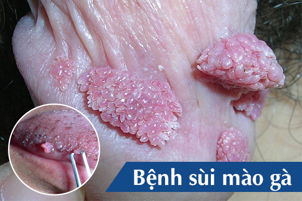 Sùi mào gà là một trong những bệnh lây truyền qua đường tình dục phổ biến do virus HPV gây ra. Sùi mào gà là một trong những bệnh lây truyền qua đường tình dục phổ biến do virus HPV gây ra.