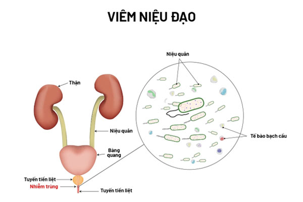Viêm niệu đạo gây ra triệu chứng như sốt, sưng đỏ lỗ tiểu, nước tiểu đục, cảm giác đau buốt khi đi tiểu. Viêm niệu đạo gây ra triệu chứng như sốt, sưng đỏ lỗ tiểu, nước tiểu đục, cảm giác đau buốt khi đi tiểu.