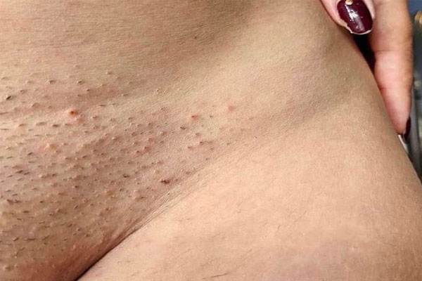 Cạo lông mu gây kích ứng da cũng là nguyên nhân gây mụn ở dương vật. Cạo lông mu gây kích ứng da cũng là nguyên nhân gây mụn ở dương vật.