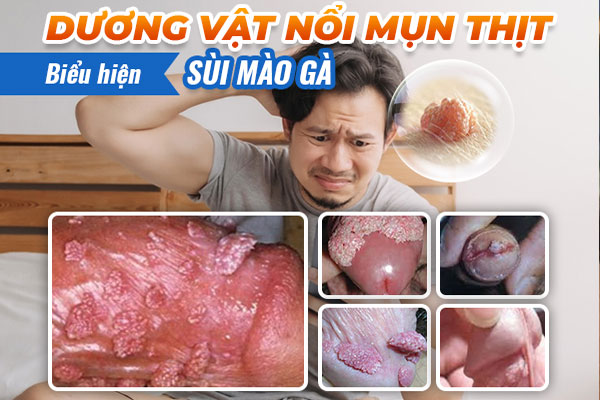Dương vật nổi mụn gây ra những ảnh hưởng trực tiếp đến sức khỏe của người bệnh. Dương vật nổi mụn gây ra những ảnh hưởng trực tiếp đến sức khỏe của người bệnh.