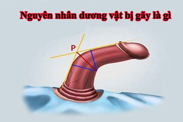 Gãy dương vật xảy ra khi dùng lực quá mạnh trong khi quan hệ tình dục. Gãy dương vật xảy ra khi dùng lực quá mạnh trong khi quan hệ tình dục.